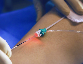 LASER ENDOVENOSO