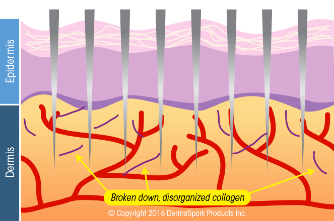 micro needling