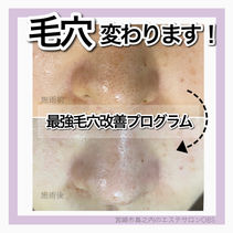 黒ずみ角栓除去.JPG