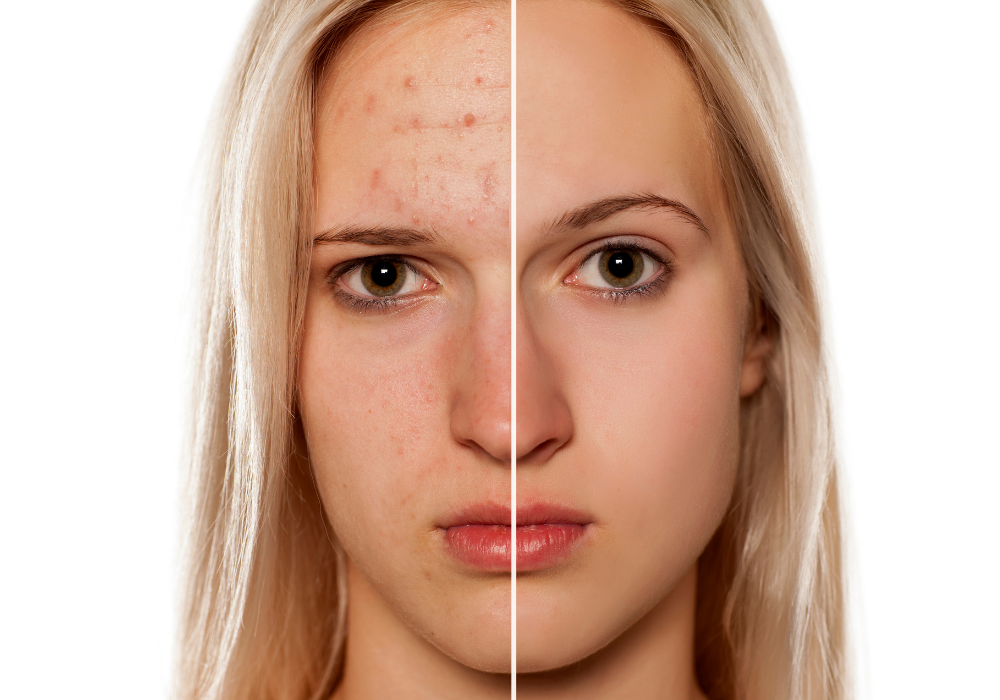 TO PREVENT ACNE, TAKE YOUR VITAMINS!