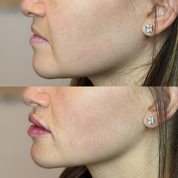 Lip Augmentation Kintsugi Medical Aesthetics Glasgow and Renfrewshire