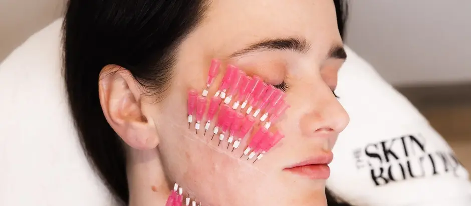 The Revolutionary Impact of Mono Threads in Aesthetic Medicine