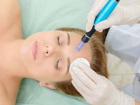 A Detailed Guide to Microneedling Treatment for Acne Scars