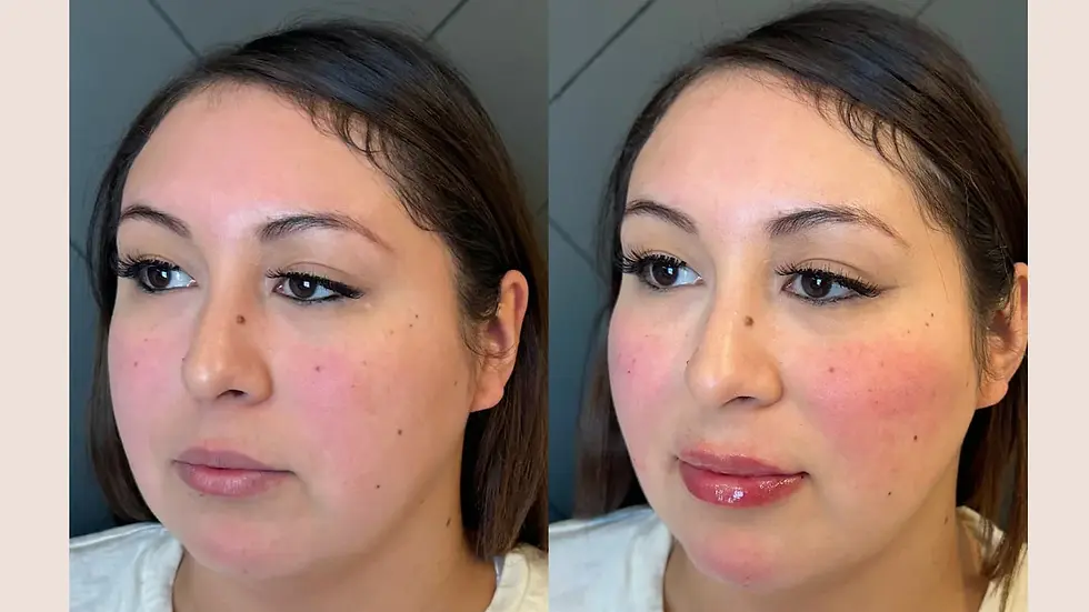 Chin fillers Melbourne