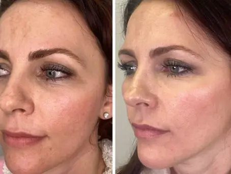 Brighter, Firmer Skin with Profhilo Debunking Common Myths