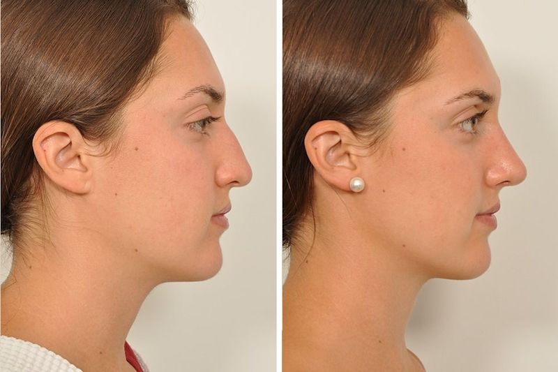 Nose filler melbourne