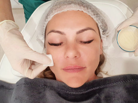 Getting the Most Out of Your Chemical Peeling Treatment