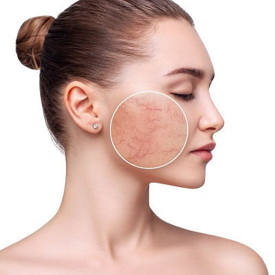 Rosacea treatment melbourne
