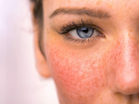 Rosacea Treatment Melbourne