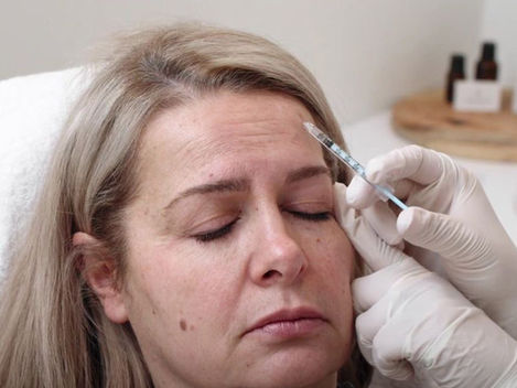 Exploring the Benefits and Side Effects of Dermal Filler Injections