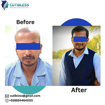 Hair Transplant Results