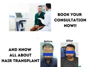 Why Choosing a Best Hair Transplant Consultation is more Important in Bangalore