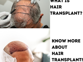 Hair Loss Solutions in Bangalore: Cutibless Offers the Best Hair Transplant Services