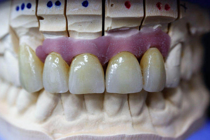 Cèramique sur zircone