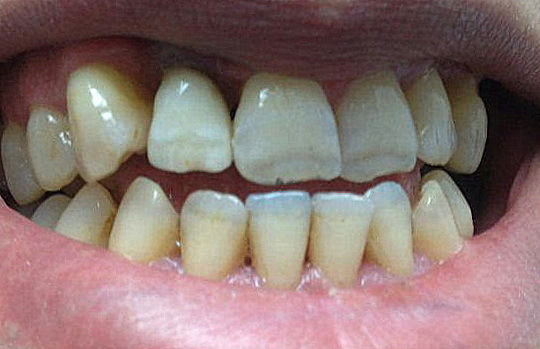 Cèramique sur zircone sur la 12