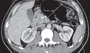 Hilum_of_the_kidney_ct_scan.jpg