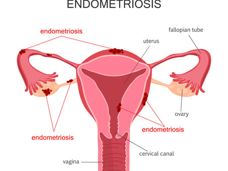 Endometriose e Musculação: O que Você Precisa Saber