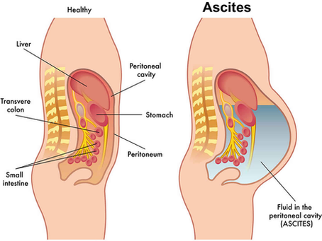 Tabagismo e Ascite: Relações e Implicações Clínicas