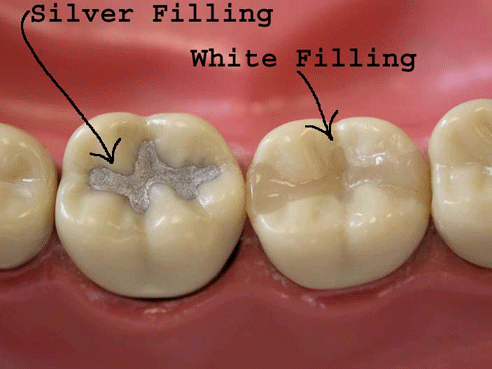 fillings.gif
