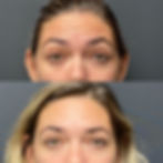 Botox before and after patient results
