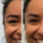 Botox before and after patient results