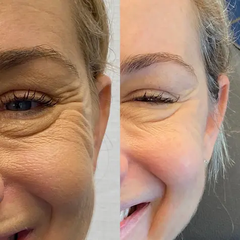 Botox to crow's feet
