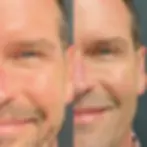Botox B&A_Apex 5.webp