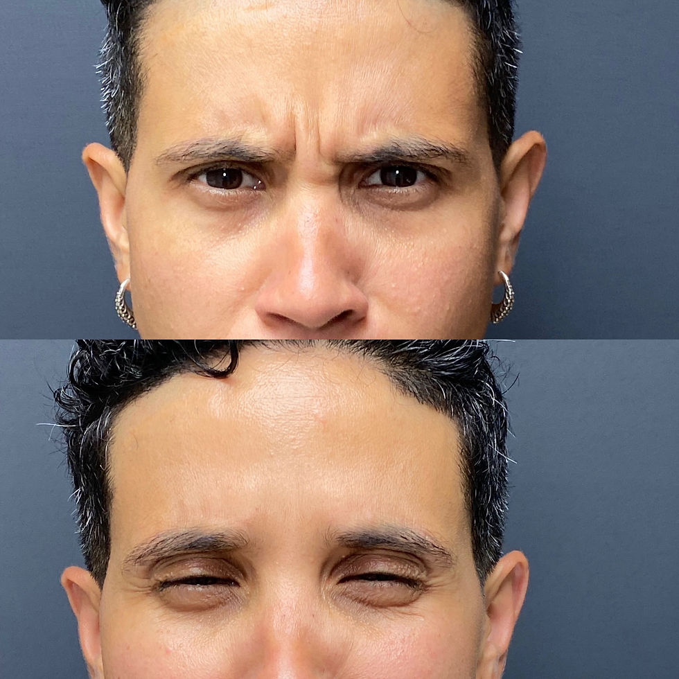 Botox before and after patient results