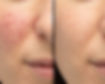 IPL Photofacial before and after