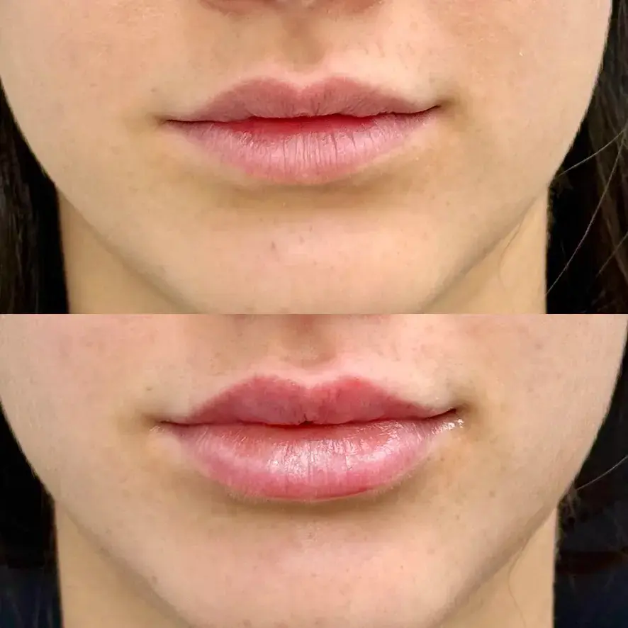 Lip filler before and after patient photo