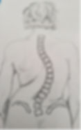 Typical Scoliosis Deformity.jpg