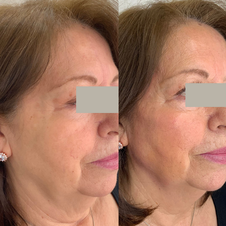 Resultados antes y después de bioestimuladores de colágeno en Concepción