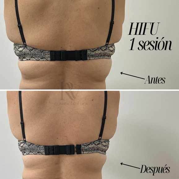 Antes y después HIFU Concepción en Clínica Estética RV