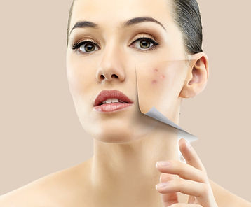 adult-acne-thumbnail_edited_edited.jpg