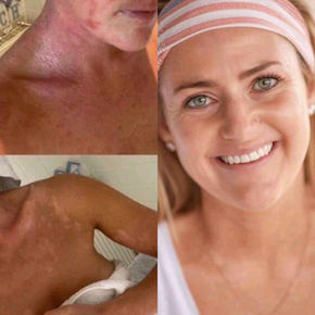 HERPES CURE 2022 HERBAL REMEDIES!