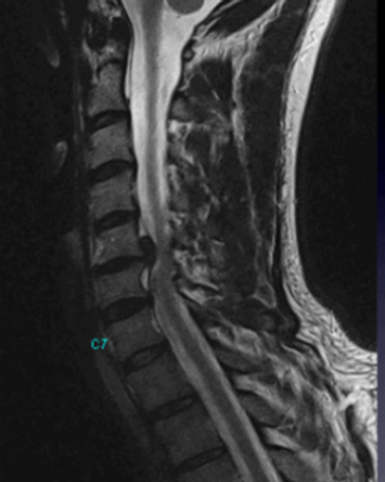 Nekhernia mri