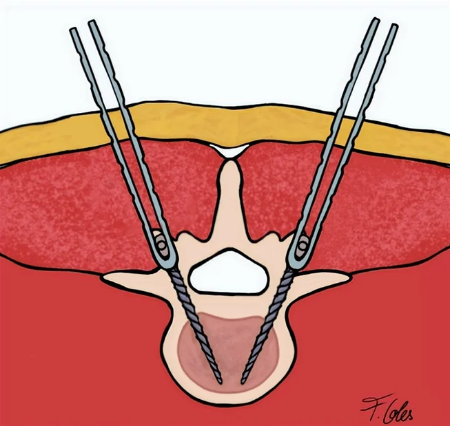drawing of Hybridspondylodese