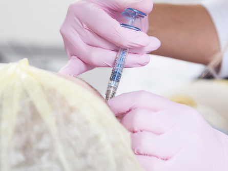 What You Need to Know About Hyper Dilute Radiesse