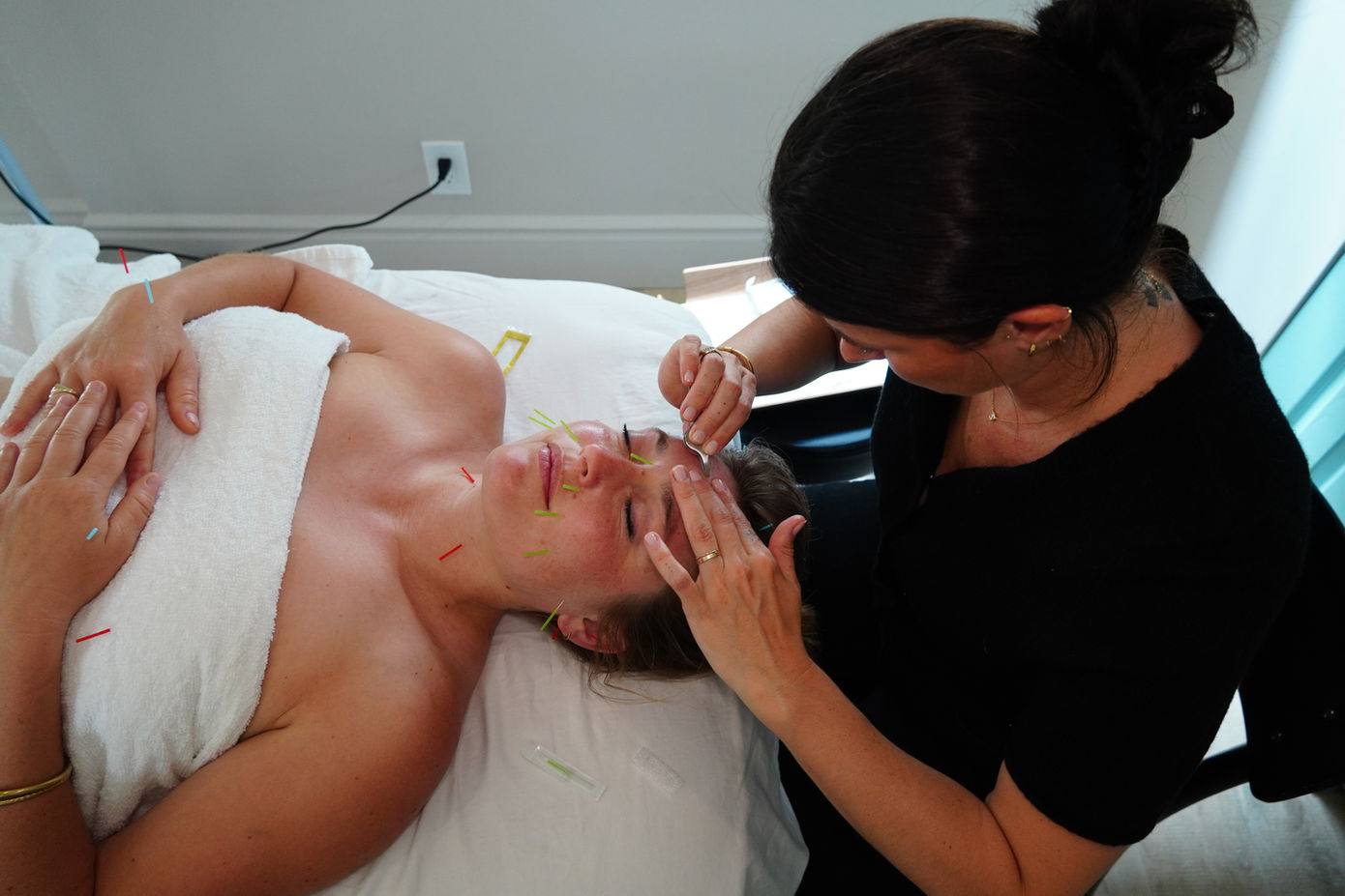 Facial acupuncture treatment: needles placed on face for rejuvenation