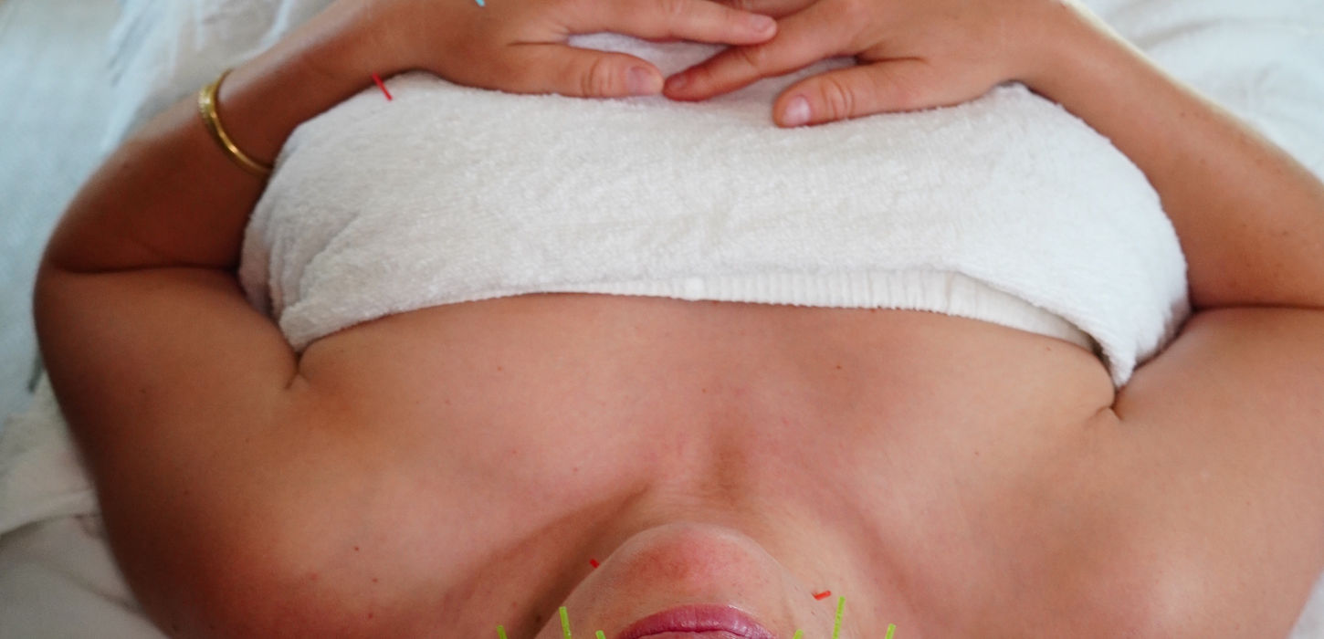 Woman receiving acupuncture facial treatment