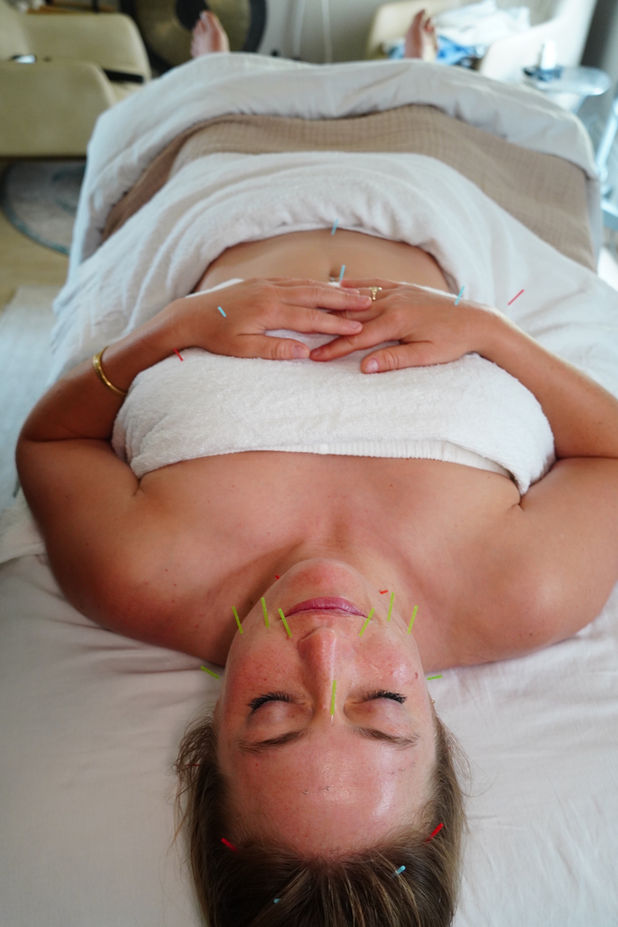 Woman receiving acupuncture facial treatment