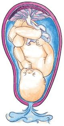 نزول ماء الراس المبكر