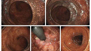 腸道紋身：酵素減肥品的恐怖真相