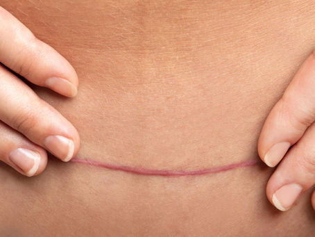 C-Section Scar Camouflage Tattoo Training in St. Petersburg FL