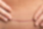 Stretch mark camouflage Tampa