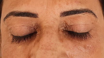 ניתוחי אוקולופלסטיקה