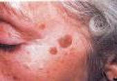 8-Actinic keratosis
