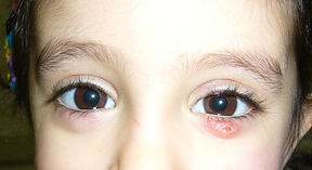 7- chalazion.