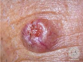 11-BCC nodular.
