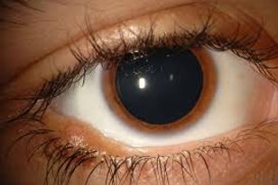 1-eyelid nevus